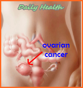 cure for ovarian cancer