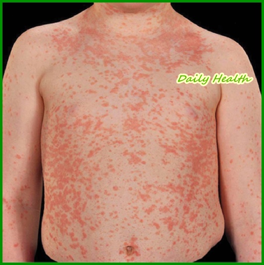 eczema kid eczema adult eczema cure