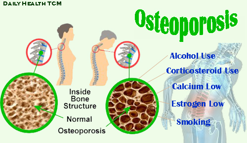 osteoporosis-disease